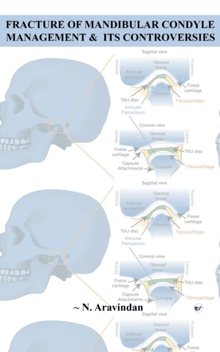 Fracture Of Mandibular Condyle Management & Its Controversies